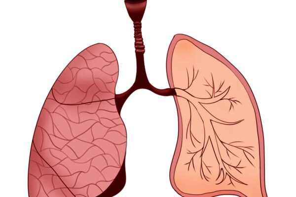 Diagnóstico Y Tratamiento Del Edema Pulmonar